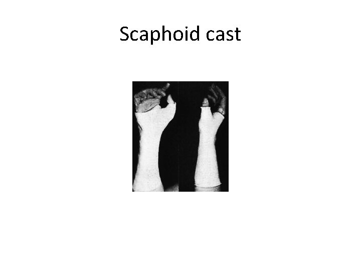 Scaphoid cast 