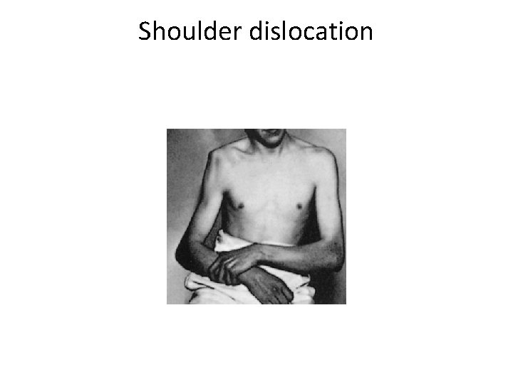 Shoulder dislocation 