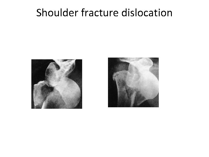 Shoulder fracture dislocation 