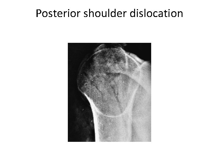 Posterior shoulder dislocation 