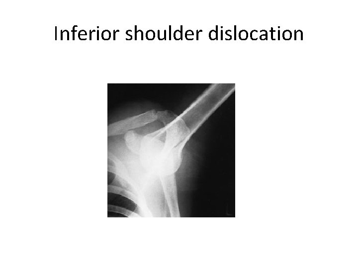 Inferior shoulder dislocation 