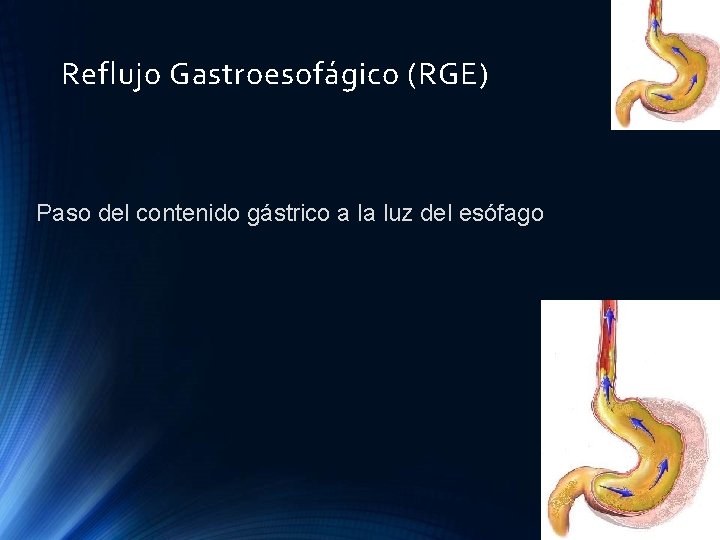Reflujo Gastroesofágico (RGE) Paso del contenido gástrico a la luz del esófago Reflujo Gastroesofágico (RGE) Paso del contenido gástrico a la luz del esófago