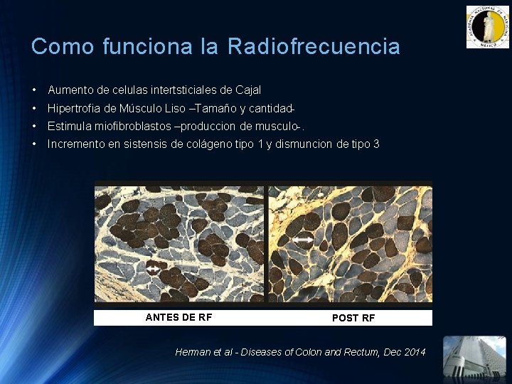 Como funciona la Radiofrecuencia • Aumento de celulas intertsticiales de Cajal • Hipertrofia de Como funciona la Radiofrecuencia • Aumento de celulas intertsticiales de Cajal • Hipertrofia de