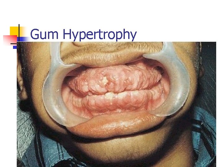 Gum Hypertrophy 