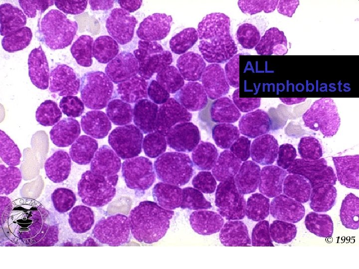 ALL Lymphoblasts 
