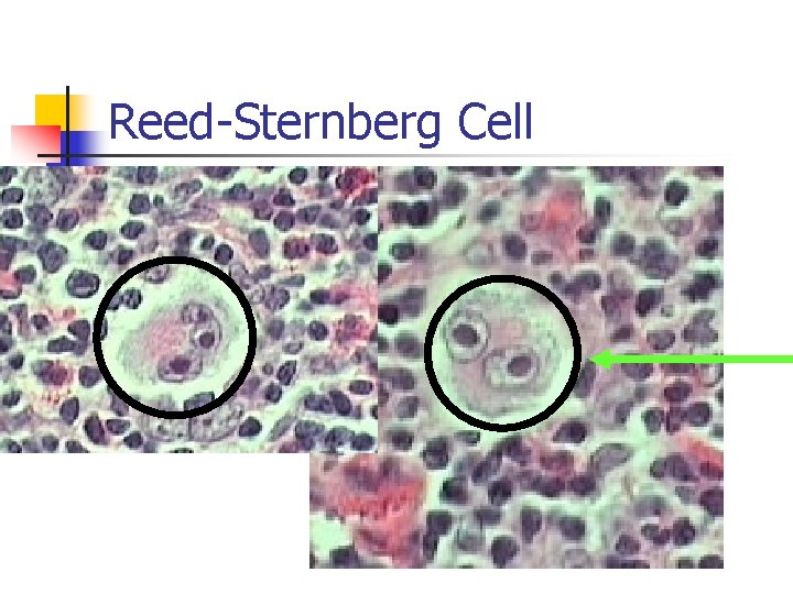 Reed-Sternberg Cell 