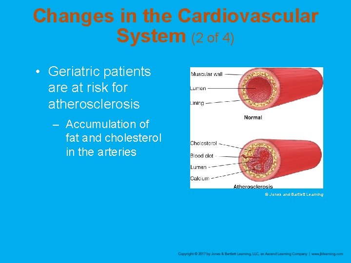 Changes in the Cardiovascular System (2 of 4) • Geriatric patients are at risk