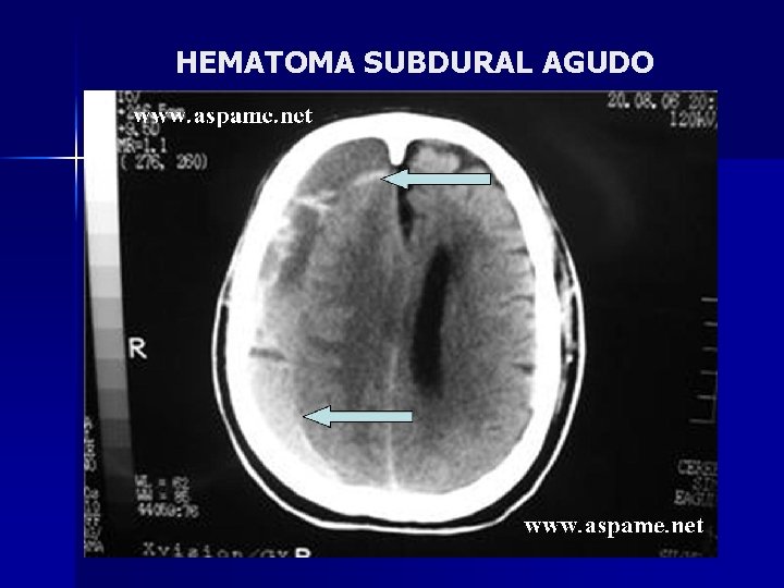 HEMATOMA SUBDURAL AGUDO 