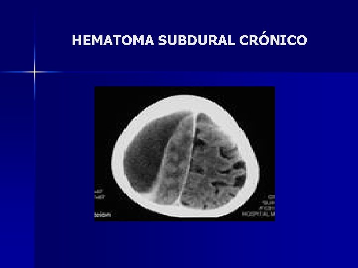 HEMATOMA SUBDURAL CRÓNICO 