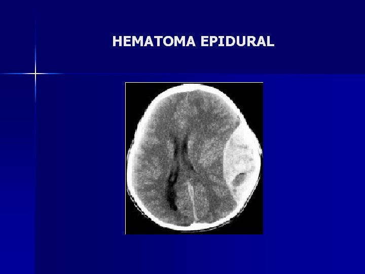 HEMATOMA EPIDURAL 