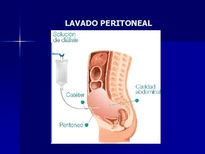 LAVADO PERITONEAL 