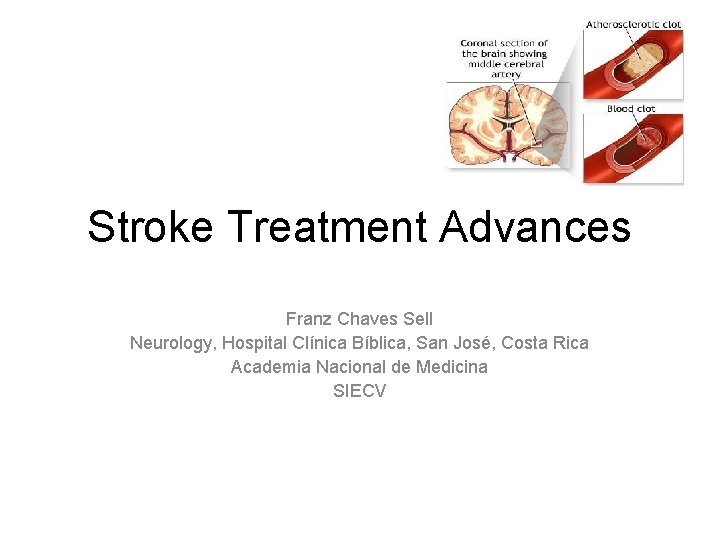 Stroke Treatment Advances Franz Chaves Sell Neurology, Hospital Clínica Bíblica, San José, Costa Rica