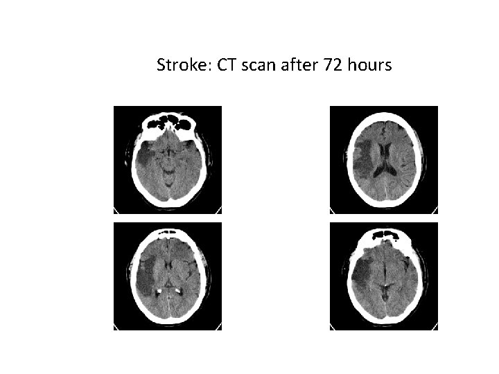 Stroke: CT scan after 72 hours 