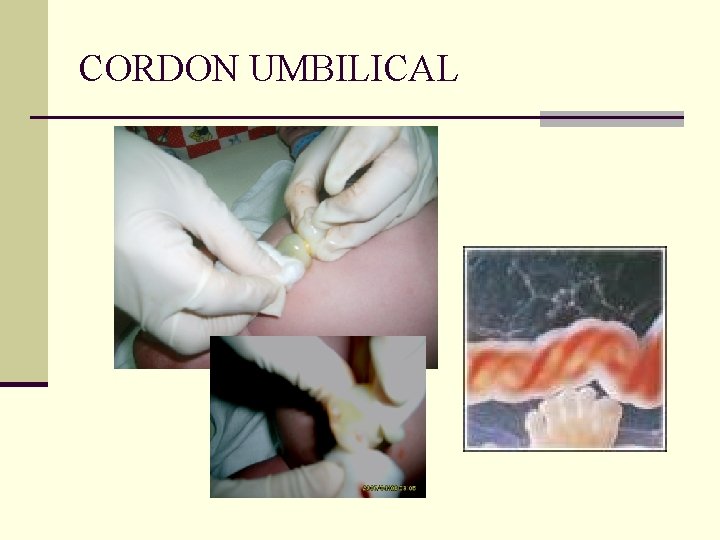 CORDON UMBILICAL 