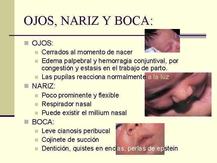 OJOS, NARIZ Y BOCA: n OJOS: n Cerrados al momento de nacer n Edema