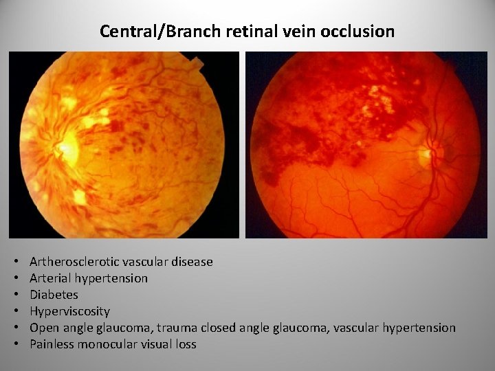 Central/Branch retinal vein occlusion • • • Artherosclerotic vascular disease Arterial hypertension Diabetes Hyperviscosity