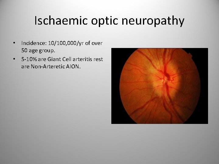 Ischaemic optic neuropathy • Incidence: 10/100, 000/yr of over 50 age group. • 5