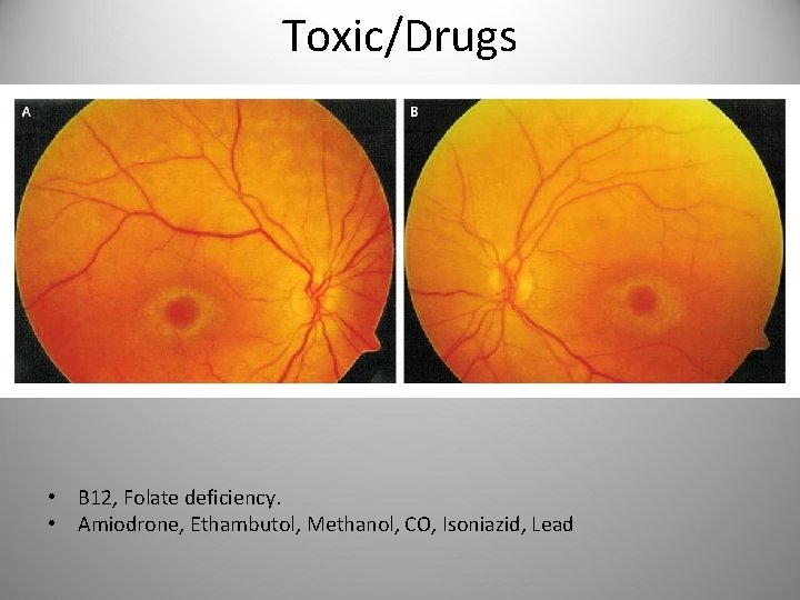 Toxic/Drugs • B 12, Folate deficiency. • Amiodrone, Ethambutol, Methanol, CO, Isoniazid, Lead 