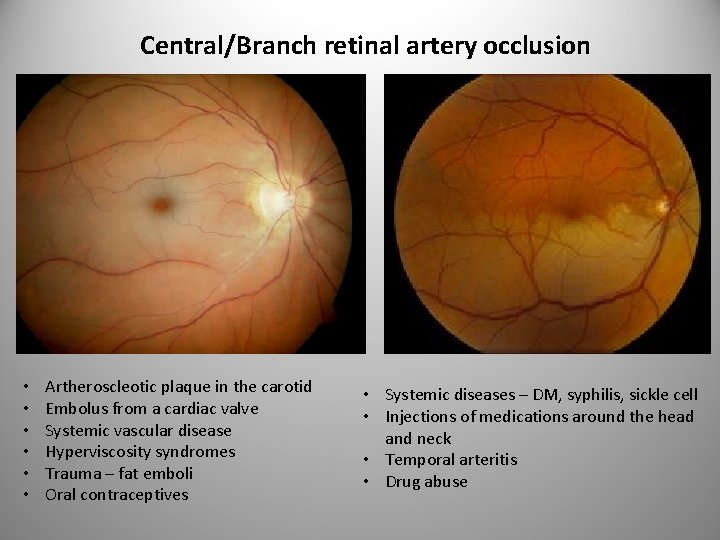 Central/Branch retinal artery occlusion • • • Artheroscleotic plaque in the carotid Embolus from