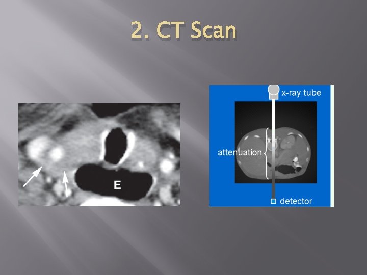 2. CT Scan 