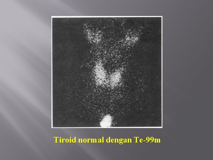 Tiroid normal dengan Te-99 m 