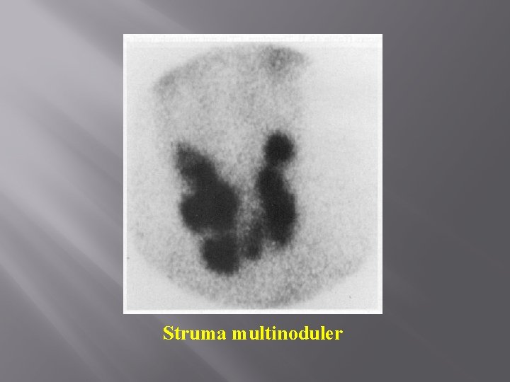 Struma multinoduler 