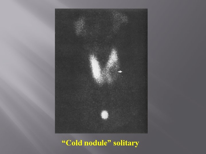 “Cold nodule” solitary 