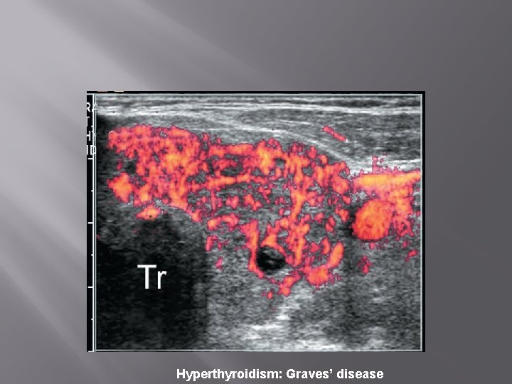 Hyperthyroidism: Graves’ disease 