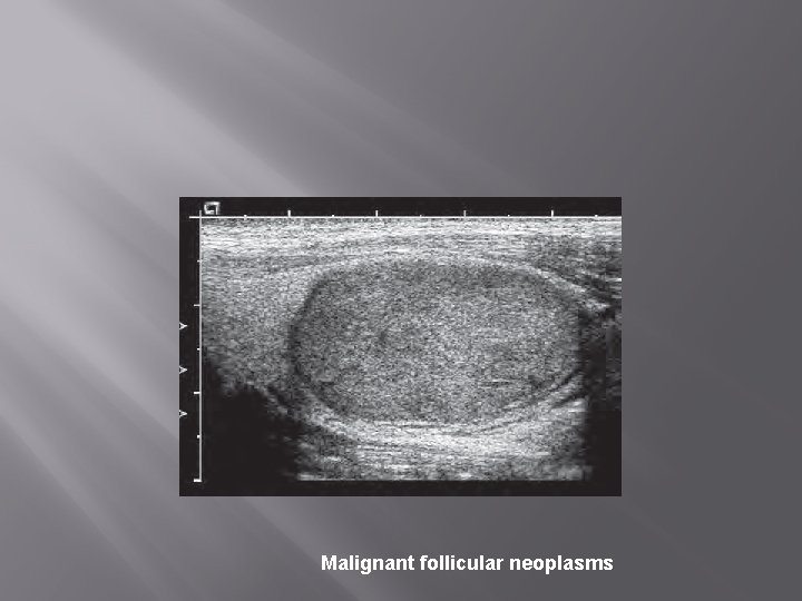 Malignant follicular neoplasms 