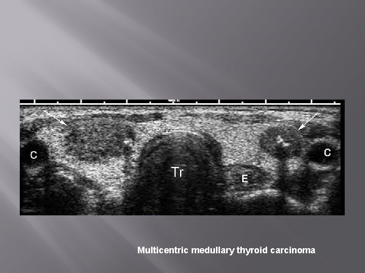 Multicentric medullary thyroid carcinoma 