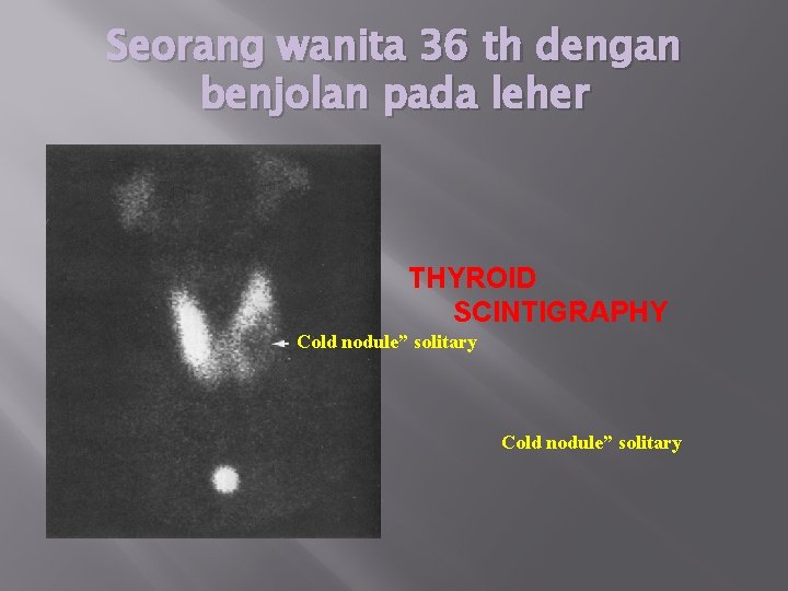 Seorang wanita 36 th dengan benjolan pada leher THYROID SCINTIGRAPHY Cold nodule” solitary 