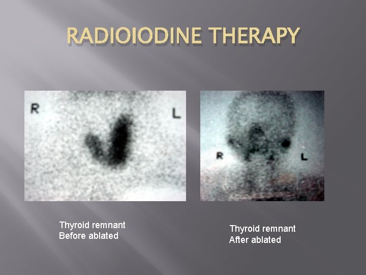 RADIOIODINE THERAPY Thyroid remnant Before ablated Thyroid remnant After ablated 