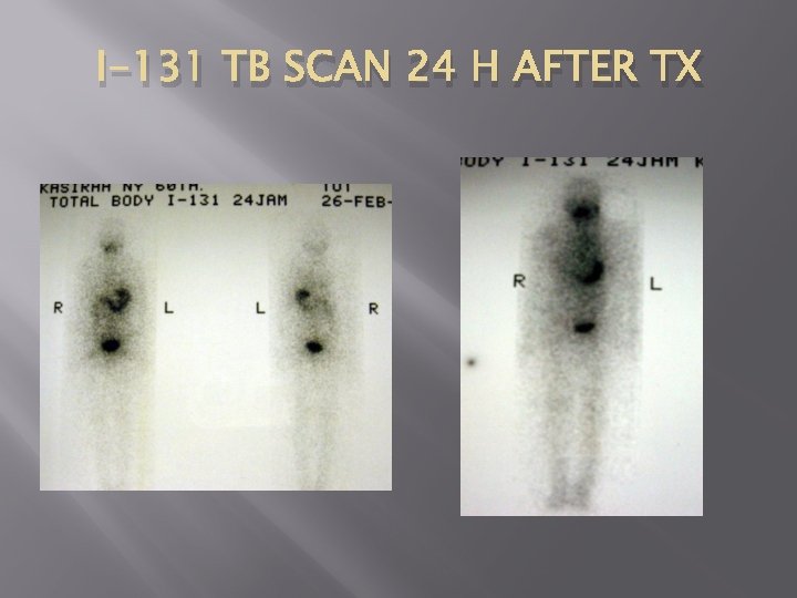 I-131 TB SCAN 24 H AFTER TX 