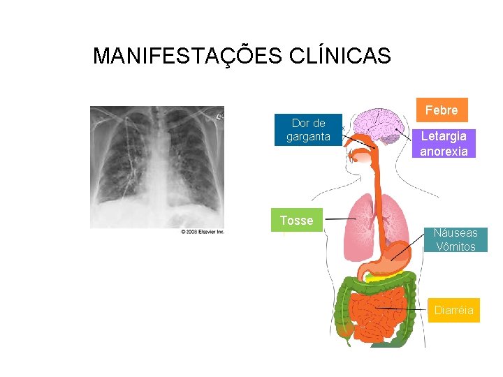 MANIFESTAÇÕES CLÍNICAS Dor de garganta Tosse Febre Letargia anorexia Náuseas Vômitos Diarréia 