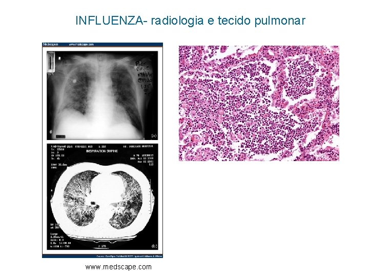 INFLUENZA- radiologia e tecido pulmonar www. medscape. com 
