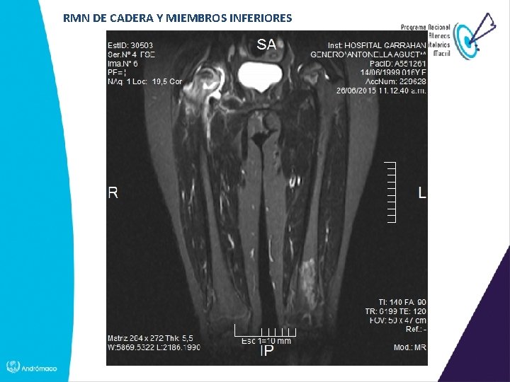RMN DE CADERA Y MIEMBROS INFERIORES 