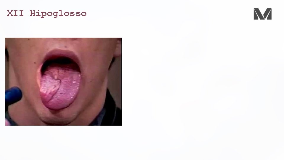 XII Hipoglosso 