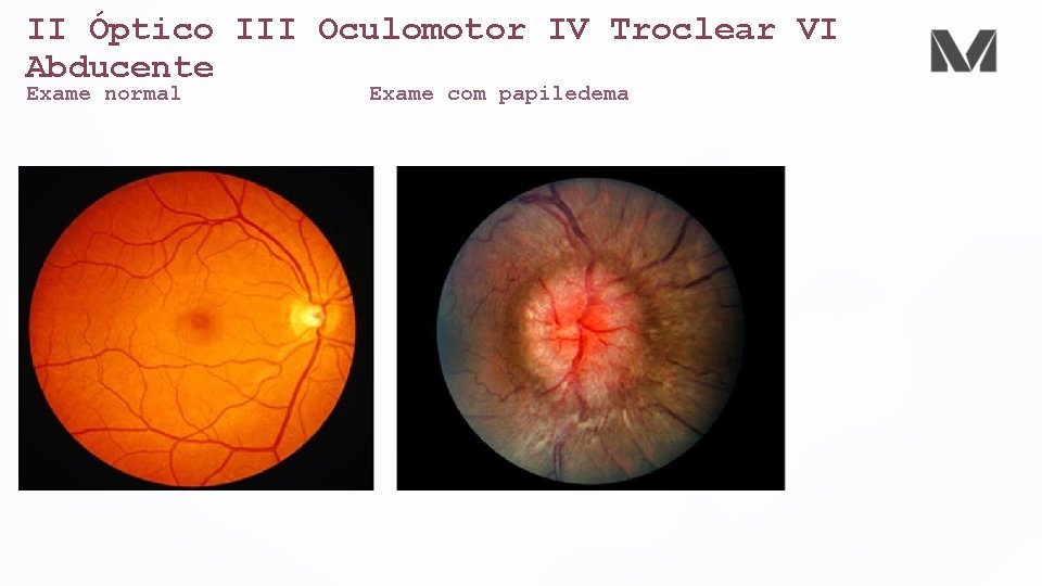 II Óptico III Oculomotor IV Troclear VI Abducente Exame normal Exame com papiledema 