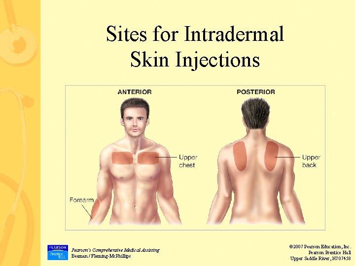 Sites for Intradermal Skin Injections Pearson’s Comprehensive Medical Assisting Beaman / Fleming-Mc. Phillips ©