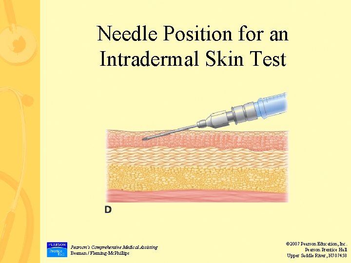 Needle Position for an Intradermal Skin Test Pearson’s Comprehensive Medical Assisting Beaman / Fleming-Mc.
