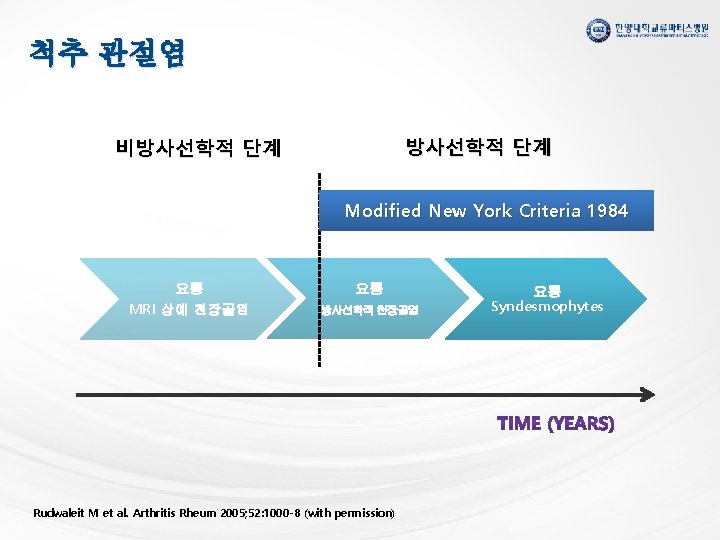 척추 관절염 방사선학적 단계 비방사선학적 단계 Modified New York Criteria 1984 요통 요통 MRI