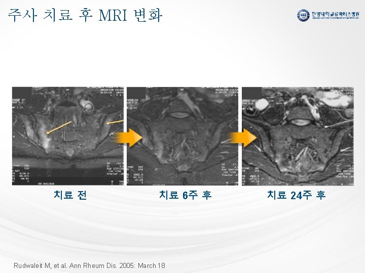 주사 치료 후 MRI 변화 치료 전 치료 6주 후 Rudwaleit M, et al.