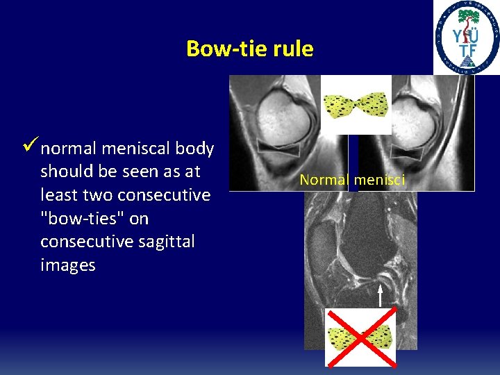 Bow-tie rule ünormal meniscal body should be seen as at least two consecutive "bow-ties" Bow-tie rule ünormal meniscal body should be seen as at least two consecutive "bow-ties"