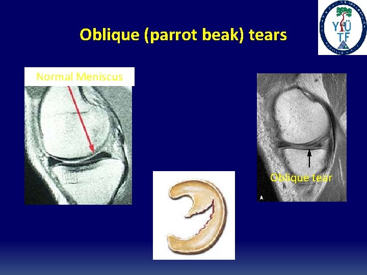 Oblique (parrot beak) tears Normal Meniscus Oblique tear Oblique (parrot beak) tears Normal Meniscus Oblique tear