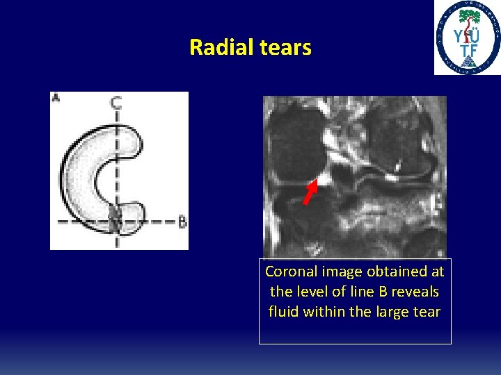 Radial tears Coronal image obtained at the level of line B reveals fluid within Radial tears Coronal image obtained at the level of line B reveals fluid within