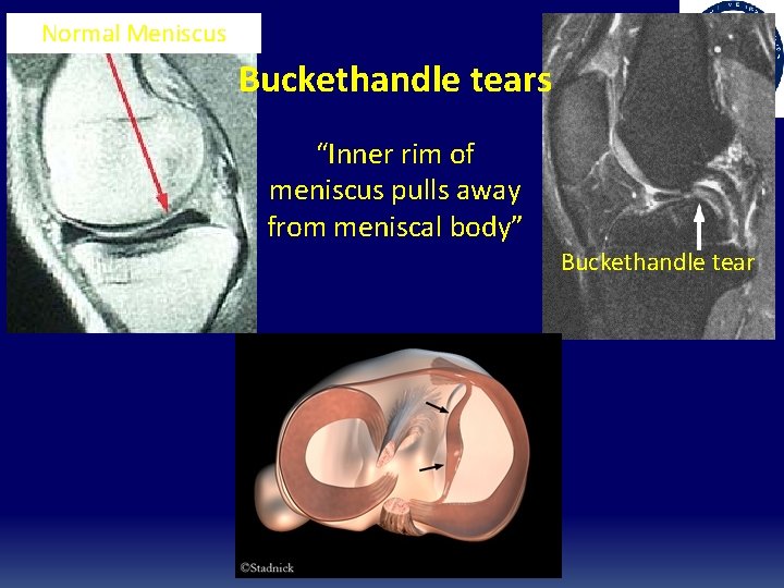Normal Meniscus Buckethandle tears “Inner rim of meniscus pulls away from meniscal body” Buckethandle Normal Meniscus Buckethandle tears “Inner rim of meniscus pulls away from meniscal body” Buckethandle