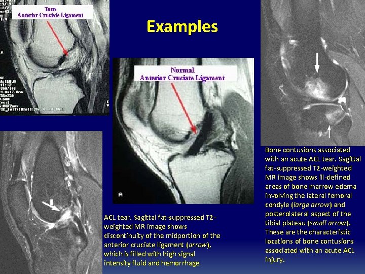 Examples ACL tear. Sagittal fat-suppressed T 2 weighted MR image shows discontinuity of the Examples ACL tear. Sagittal fat-suppressed T 2 weighted MR image shows discontinuity of the
