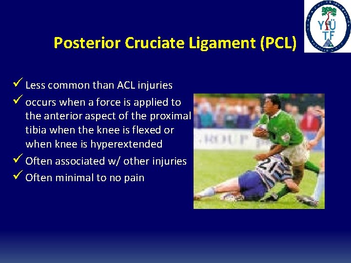 Posterior Cruciate Ligament (PCL) ü Less common than ACL injuries ü occurs when a Posterior Cruciate Ligament (PCL) ü Less common than ACL injuries ü occurs when a
