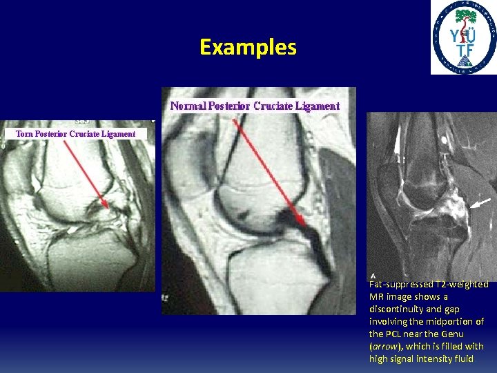 Examples Fat-suppressed T 2 -weighted MR image shows a discontinuity and gap involving the Examples Fat-suppressed T 2 -weighted MR image shows a discontinuity and gap involving the