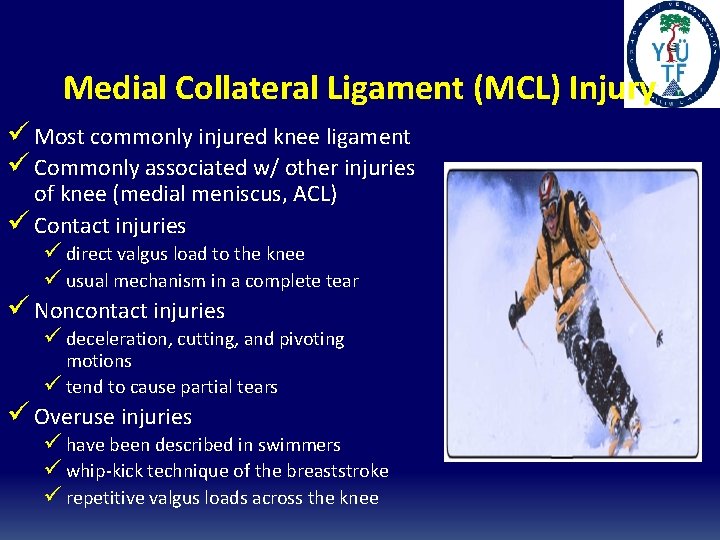 Medial Collateral Ligament (MCL) Injury ü Most commonly injured knee ligament ü Commonly associated Medial Collateral Ligament (MCL) Injury ü Most commonly injured knee ligament ü Commonly associated